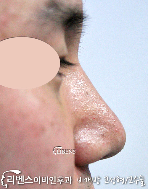 비대칭 콧구멍 화살코 교정 수술 매부리코 메부리코 코끝 비중격만곡증 성형 s112